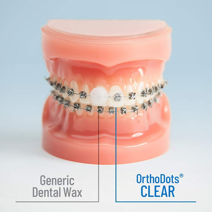OrthoDots CLEAR - Moisture Activated, Silicone Dental Wax Alternative for Pain Caused by Braces. OrthoDots Stick Better & Stay on Longer than Orthodontic Wax 24 Count Clear