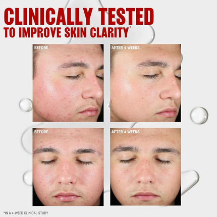 Tónico Thayers para imperfecciones con ácido salicílico, tónico facial para el acné con 2% de ácido salicílico, cuidado de la piel calmante y no astringente, 355 ml