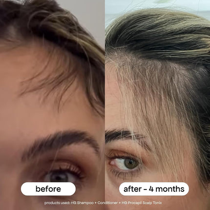 BondiBoost Procapil Hair Tonic 4.23 fl oz - Leave-In Treatment for Thinning Hair - Reduce Hair Fall + Increase Hair Density - Lightweight Non-Greasy Formula - Vegan/Cruelty-Free - Australian Made
