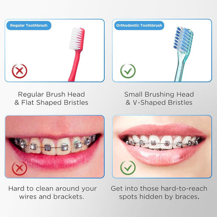 Fregum V-Shaped Orthodontic Toothbrush for Braces with Cover, Soft Bristles