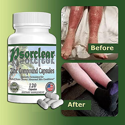 PSORCLEAR-For Psoriasis & Eczema Relief | A Proven Effective and All-Natural Product for Relief of Psoriasis Eczema and Rosacea That Works (120 Count Bottle)-Rated One of the Best!