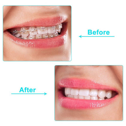 100 Pieces Aligner Chewies for Aligner Chompers Aligner Trays Seater Orthodontic Dental Chewies, White Green Orange Pink and Purple