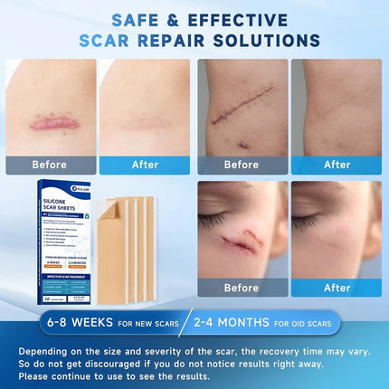 Rvlaim Silicone Scar Sheets, Silicone Scar Tape(5.7” x 1.57” 10 Pcs)