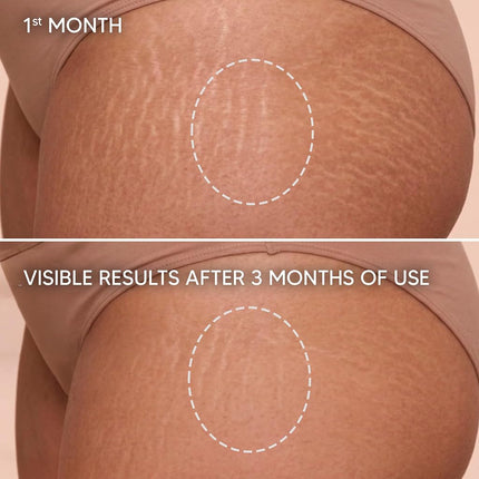 Cicatrissim Crema Eliminadora de Estrías - Innovadora Fórmula Natural con Ingredientes Puros y Potentes de la Flora Brasileña. Dile Adiós a las Estrías y Recupera tu Autoestima