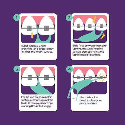 Platypus Orthodontic Flossers for Braces | Ortho Picks for Adults & Kids | Fits Under Arch Wire | Non-Damaging | Encourage Flossing Habits | Floss Teeth in Less Than Two Minutes | 40 Count (Pack of 1)
