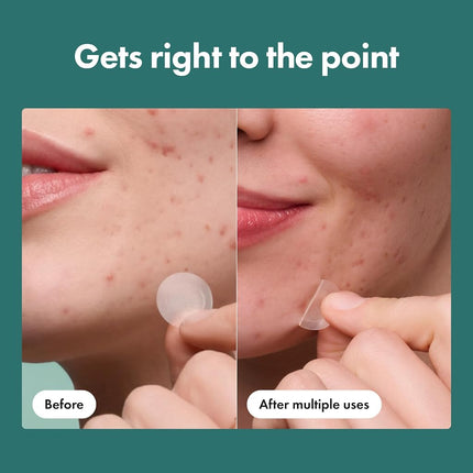 Mighty Patch Hero Cosmetics Micropoint Acne Pimple Patches, 8 Ct