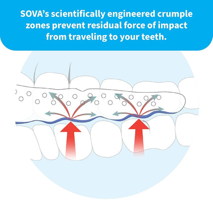 SOVA Aero Night Guard - 1.6mm Thin - Custom-Molded Fit - Protects Against Nighttime Teeth Grinding & Clenching - FSA/HSA Eligible - Odor & Taste Free - Remoldable Up to 20 Times - Non Toxic