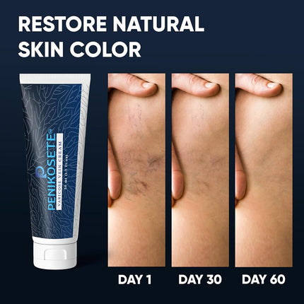 Penikosete Varicose Veins Cream | Natural Ayurvedic Cream for Legs with Ashwagandha | Spider Vein Removal Cream for Improved Circulation & Relief From Heavy Fatigued Legs | Non-Sticky