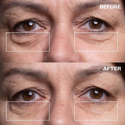 Wrinkles Schminkles Under Eye Patches - Rejuvenate Wrinkles with Medical Grade Silicone Reusable Anti-Wrinkle Patches for Under Eye Treatment, Banish Dark Circles (3 Pairs)