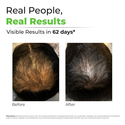 AVIMEE HERBALKeshpallav Hair Oil For Men & Women | Promotes Hair Growth & Reduces Hair Fall | With Rosemary, Castor, Amla, Coconut and Bhringraj Oil | Mineral Oil Free (Pack of 2)