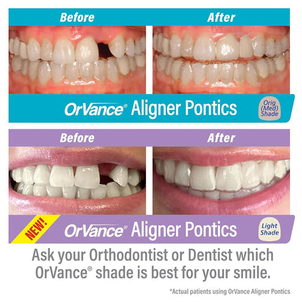 ORVANCE Aligner Pontics - Light Shade (16 Count) | Fills The Space of Missing Teeth in Clear aligners and Retainer Trays