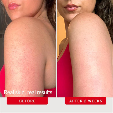 First Aid Beauty KP Bump Eraser Body Scrub with 10% AHA, Keratosis Pilaris Skin Exfoliator with Glycolic and Lactic acids, Helps Reduce Chicken Bumps, Safe for Sensitive Skin, 8 oz