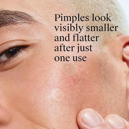Neutrogena Stubborn Acne Pimple Patches, Acne Treatment for Face, Ultra-Thin Hydrocolloid Spot Stickers Provide Optimal Healing for Pimples, 24 Patches